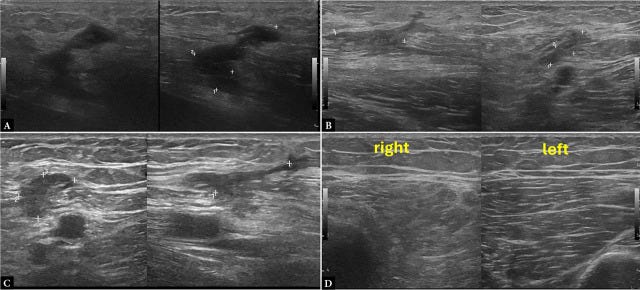 Hematoma ecografia tempo formacion 3.jpg